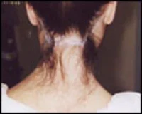 Electrolysis - Hair Line Before