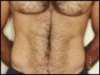 Electrolysis - Ab Sculpting Before