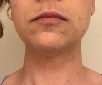 Electrolysis - Facial Hair Removal After