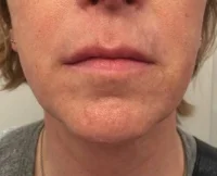Electrolysis - Facial Hair Removal After