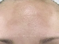 Hyperpigmentation Treatment After