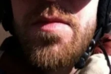 Electrolysis - Facial Hair Removal Before