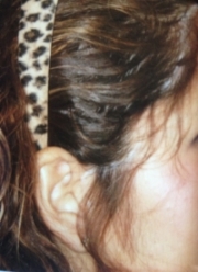 Electrolysis - Hair Line Before