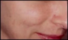 Electro-Luxe Facial Acne Treatment After