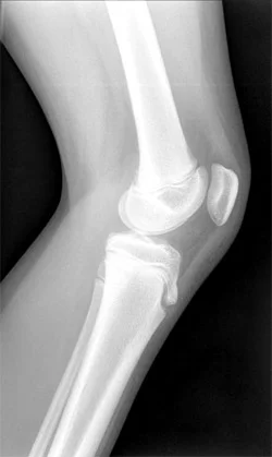 Knee pain in younger athletes
