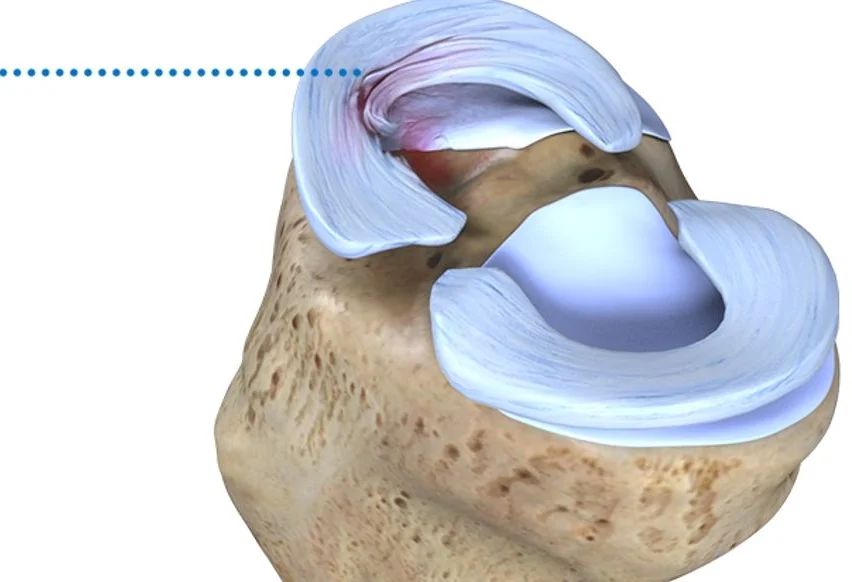 Conservative Management of Meniscal Tear