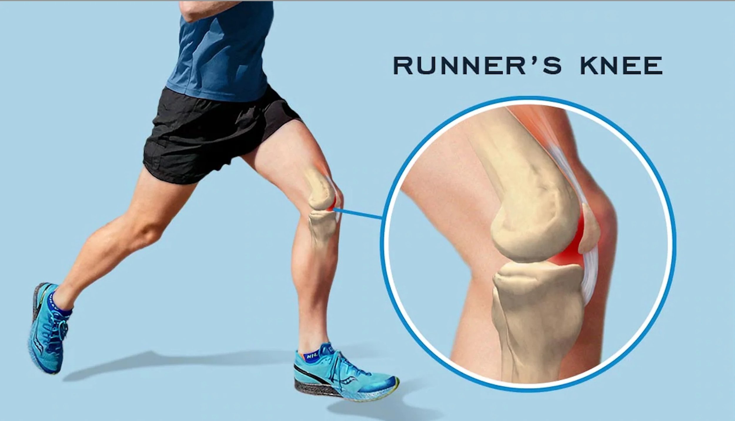 Strategies to Prevent Runner’s Knee