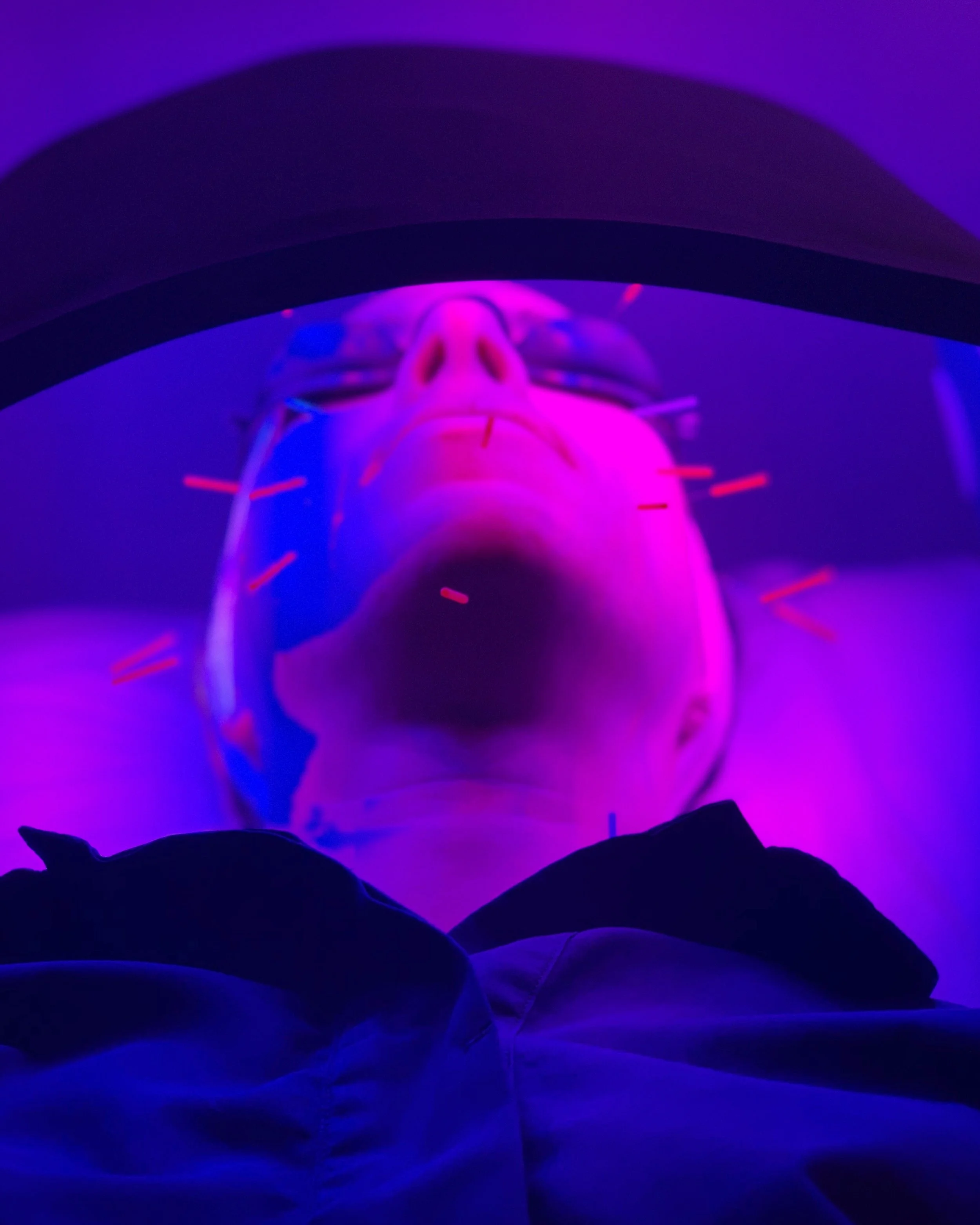 Rejuvenate your skin with Facial Acupuncture