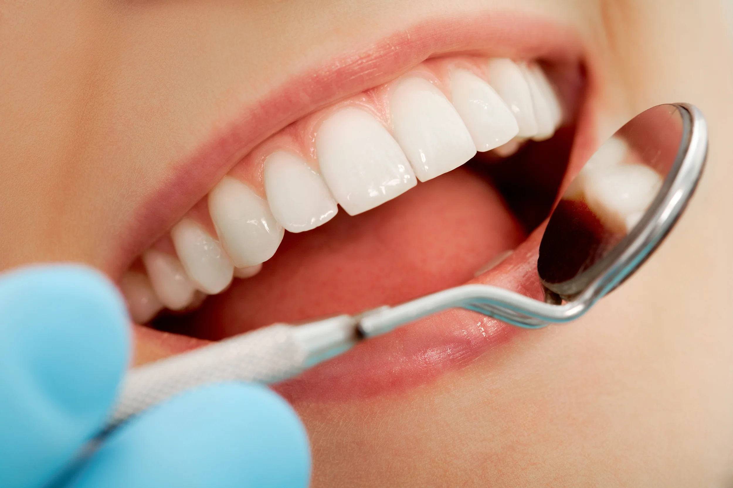 Ultrasonic Cleanings we use the latest in ultrasonic technology so your teeth feel squeaky clean for days after. When treating you, we will remove calculus (calcified plaque) and plaque deposits by meticulously cleaning your teeth with special instruments. Dr. Cho will show you a daily routine for removing plaque from your mouth, which involves thorough cleaning with toothbrush and fluoride toothpaste. You will also be shown how to remove plaque from between teeth with floss or a small inter-dental brush.