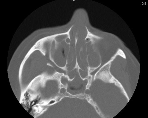 Typical 2D CAT Scan
