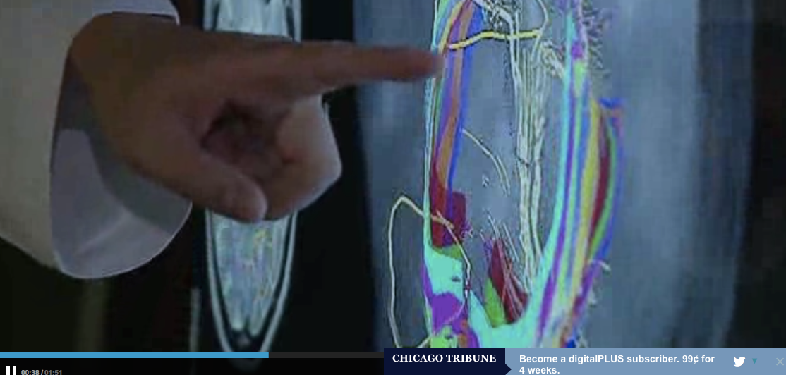 Advanced  Mapping Of The Brain Helps Preserve Human Functions During Cancer Treatment