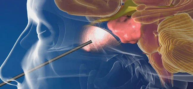 Pituitary tumor surgery