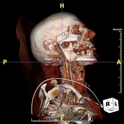 Advanced imaging for surgical planning