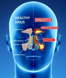 Traditional treatment of Chronic Rhinosinusitis  - an update