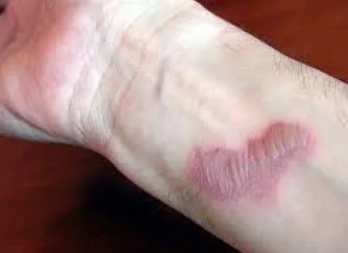 Burn Healing 