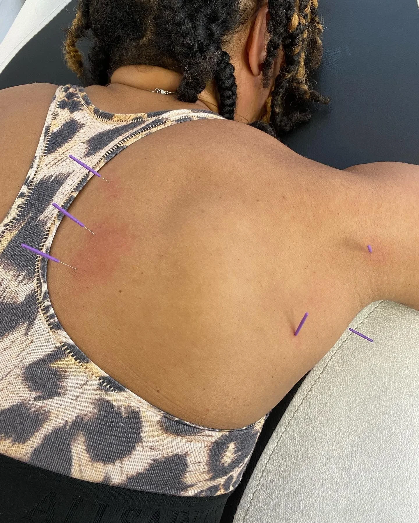 How Dry Needling Could Help You
