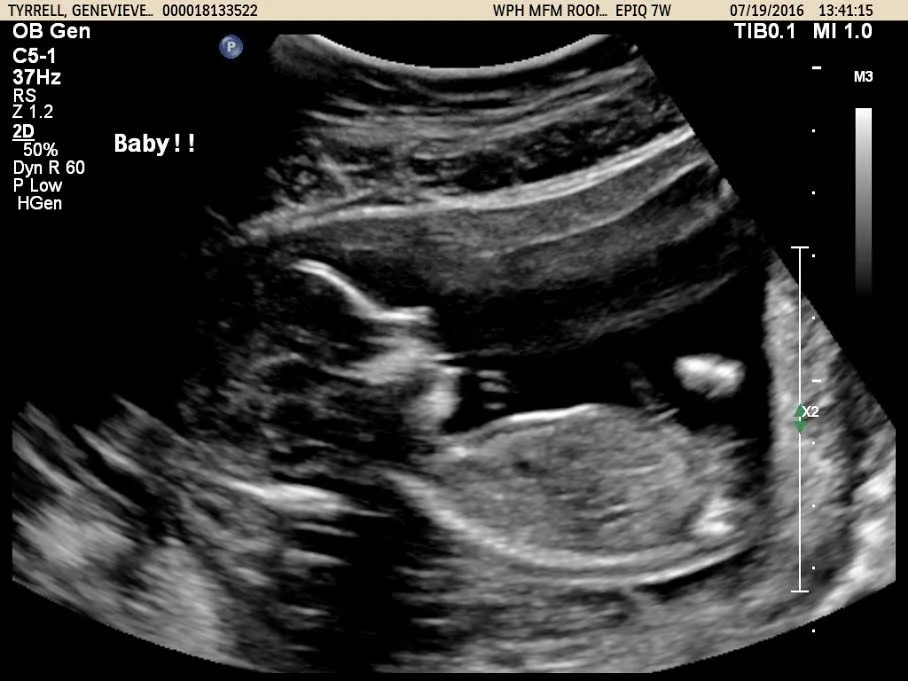 Note to self: Sometimes the most disgruntled ultrasound techs give the most happy exclamation-pointy ultrasound pictures.