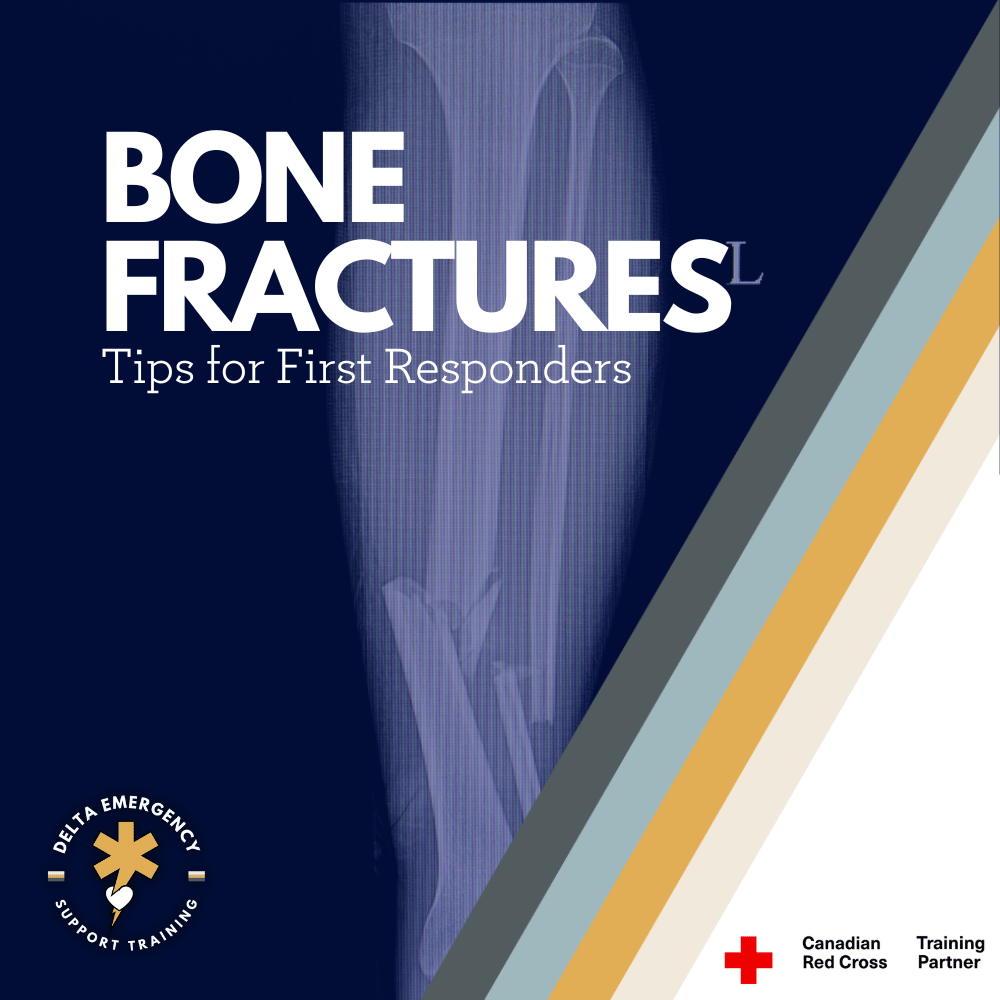 Handling Bone Fractures: Essential Tips for First Responders