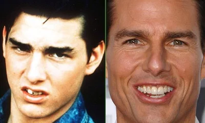 Tom Cruise - Smile makeover