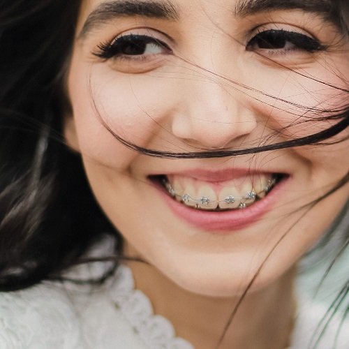 should i get braces 2.jpg