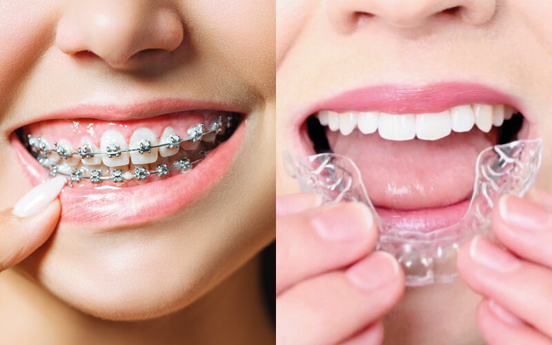 Invisible Braces for Adults: Is it ever too late?