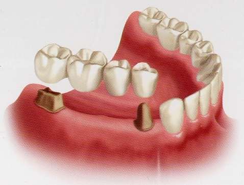 several-teeth-2.jpg