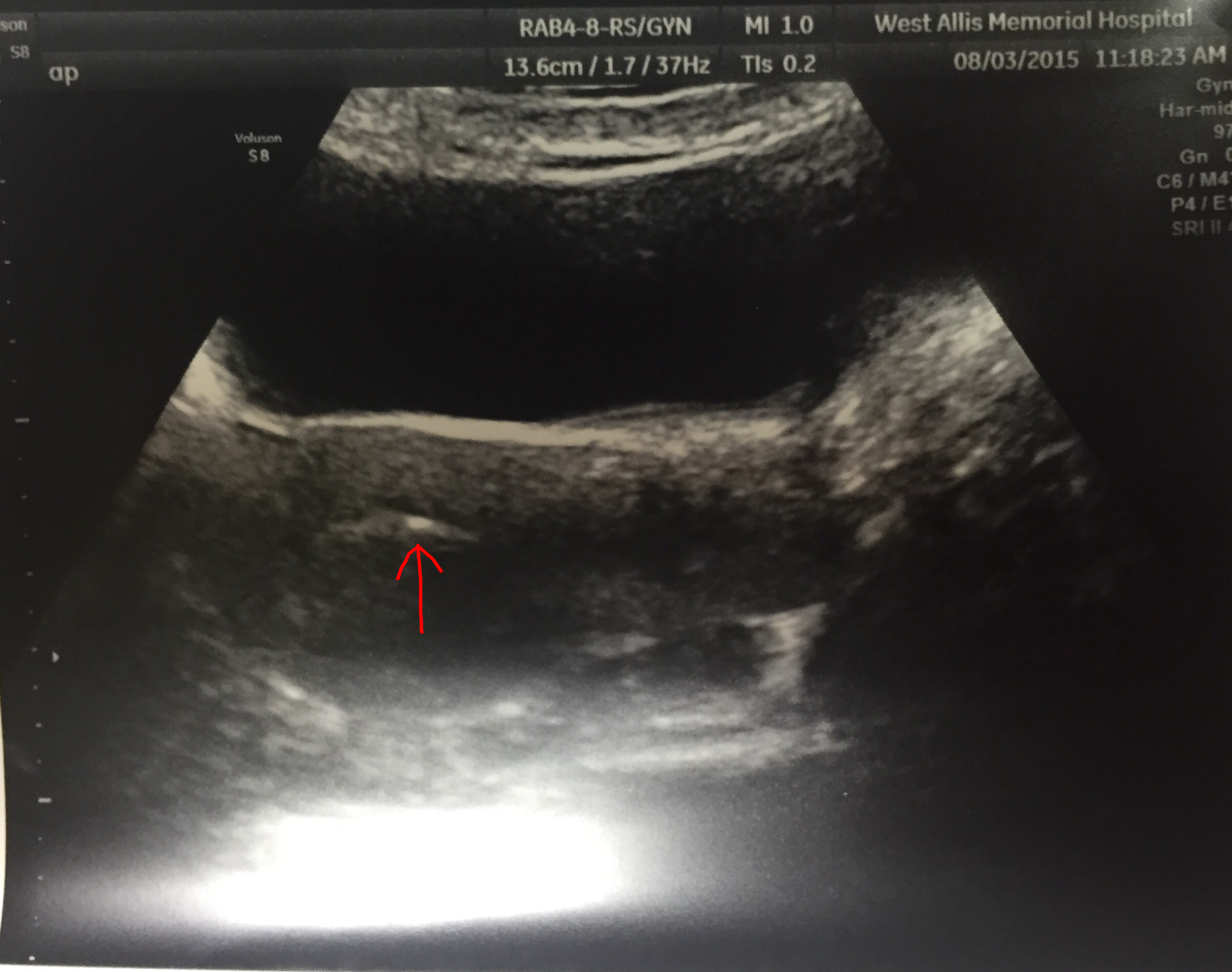 Embryos post-transfer (the arrow is where the embryo's are): August 3, 2015