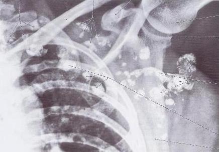 Radiographic scan of congested lymph nodes.