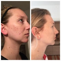 A before and after photo of a patient with chronic skin issues.