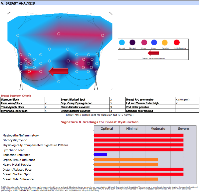 Initial Breast Thermography showing breast blockages and inflammation consistent with wearing a bra 24 hours a day.