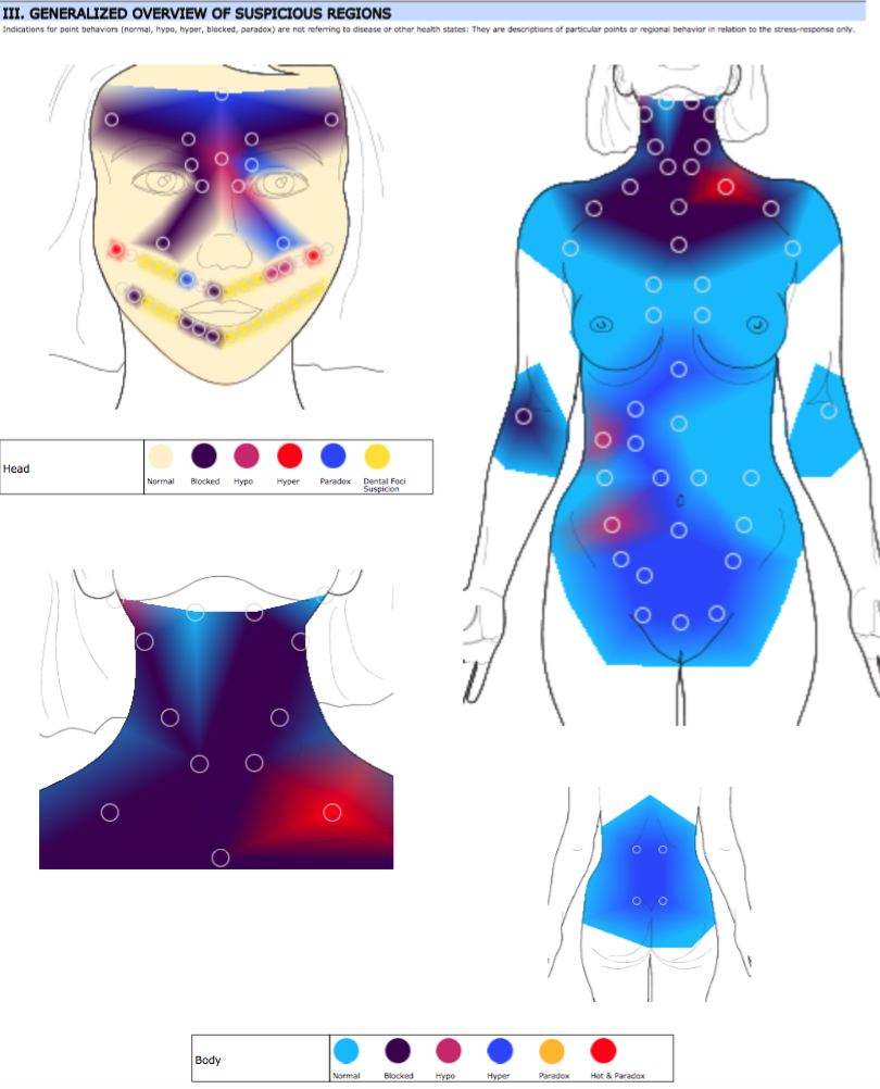Initial Body Thermography showing severe blockages to circulation and lymphatic flow affecting the head, neck and upper chest.