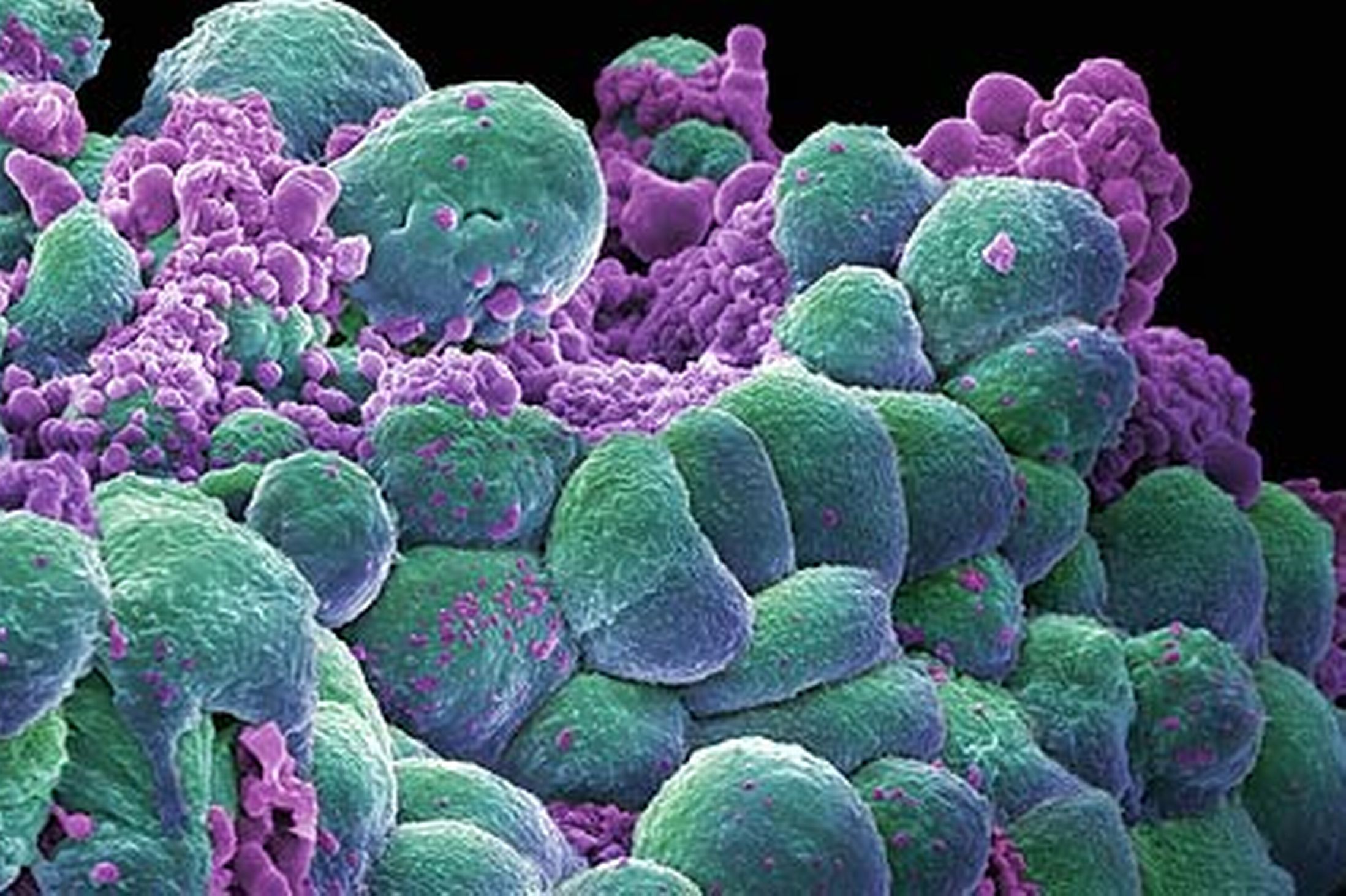 Stagnant lymph flow causes lymphocytes to be invaded by cancer cells.