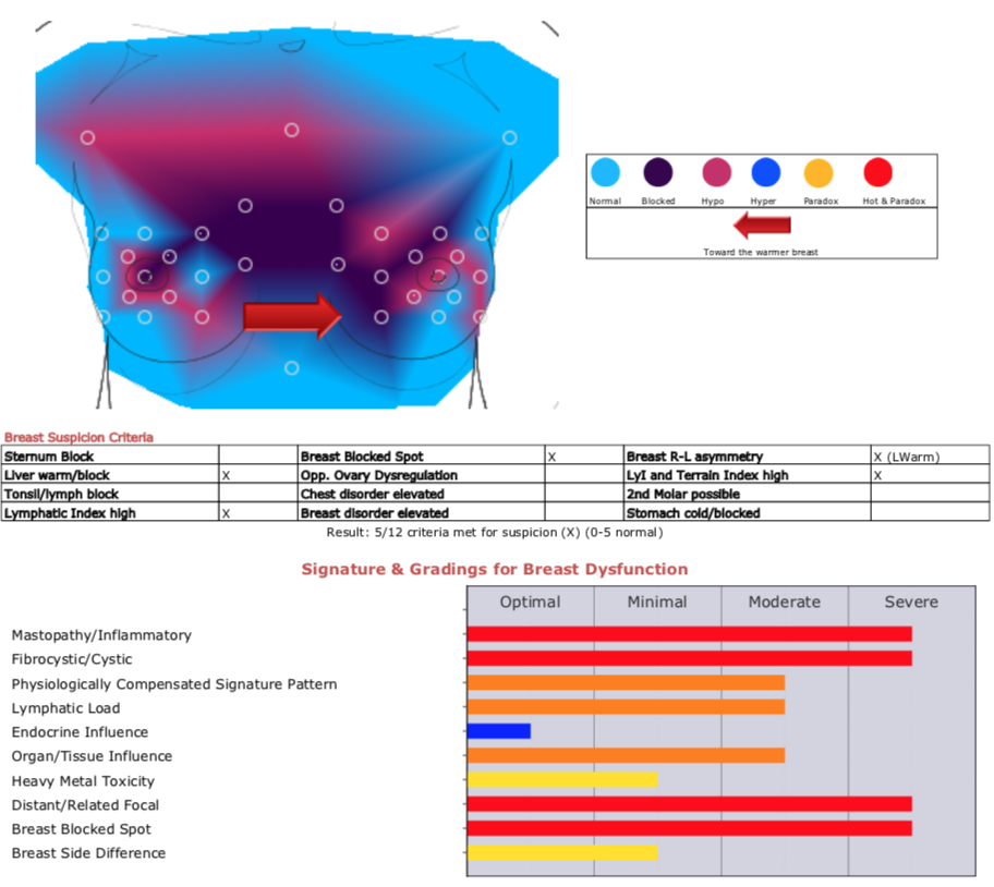 Initial Thermography Breast Scan