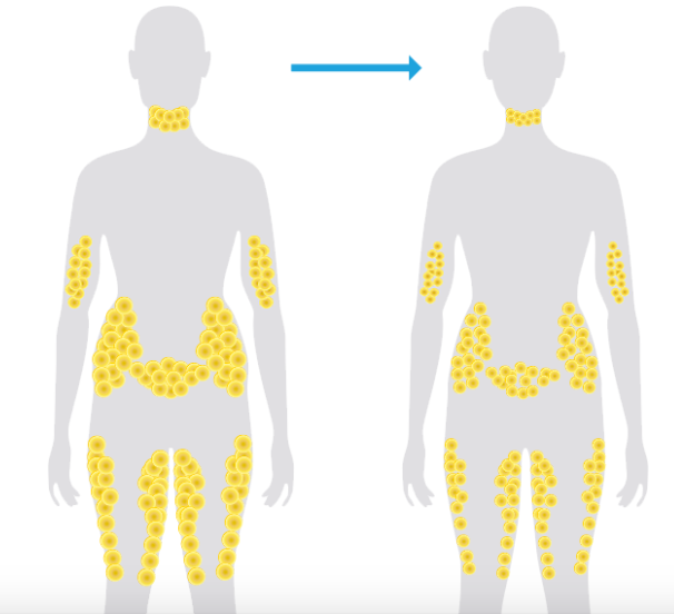 How Does Fat Leave the Body After CoolSculpting?