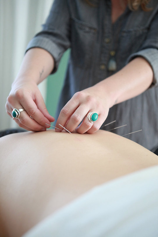 Acupuncture