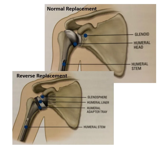 Shoulder Replacement.jpg