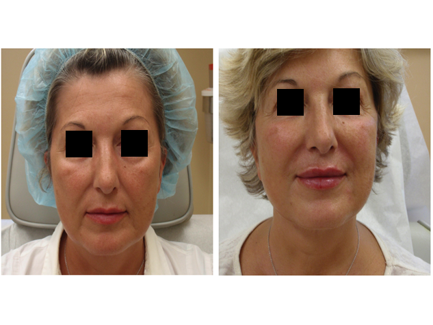 Juvederm in the lips, smile lines and cheeks
