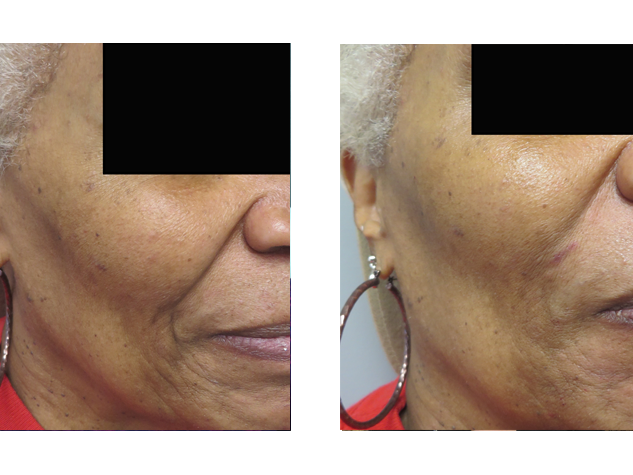Marionette lines are the vertical lines that start at the corners of your mouth and run down to your chin. Note the improvement of the above patient's marionette lines with Juvederm .