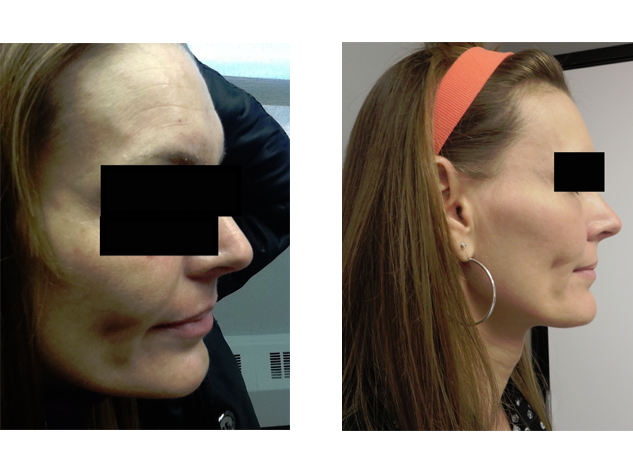 Forehead wrinkles reduced after Xeomin
