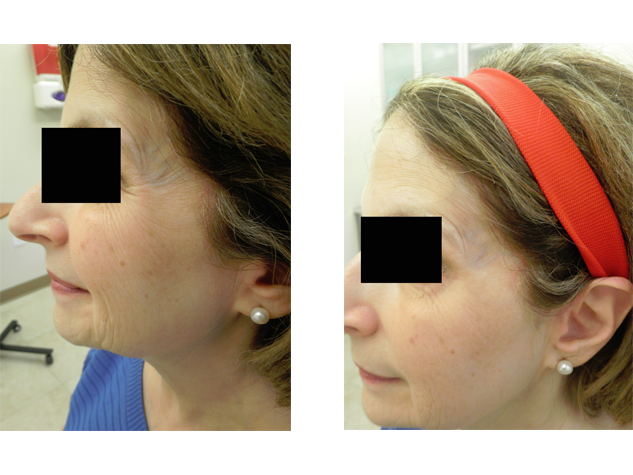 Wrinkles around the eyes are relaxed with Botox .