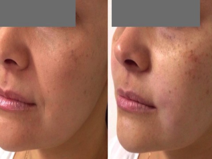 No downtime skin rejuvenation. Courtsey of Adrian Gasper