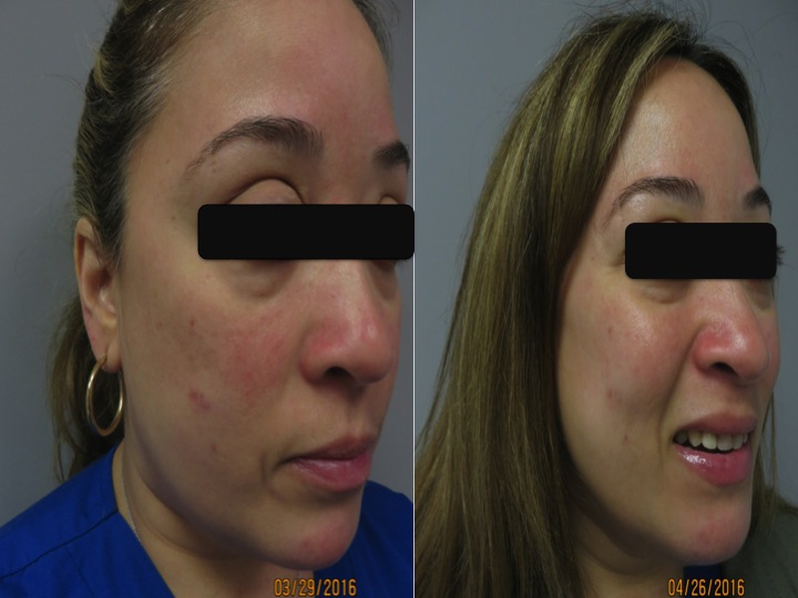 Note the reduction in the redness and acne like lesions in less than one month. She is ecstatic!