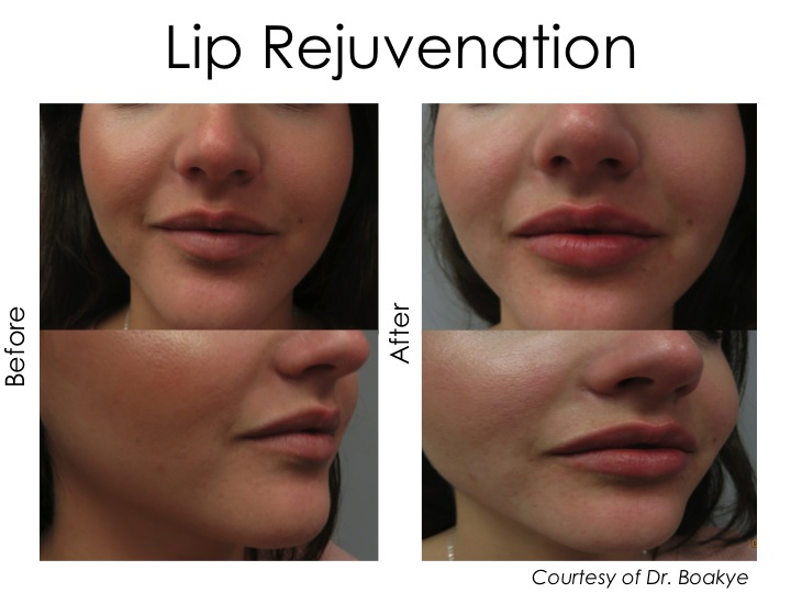 Lip Rejuvenation can be achieved with fillers for a smoother and more youthful lip. The goal is to make it look natural. Restylane silk was used during this treatment.