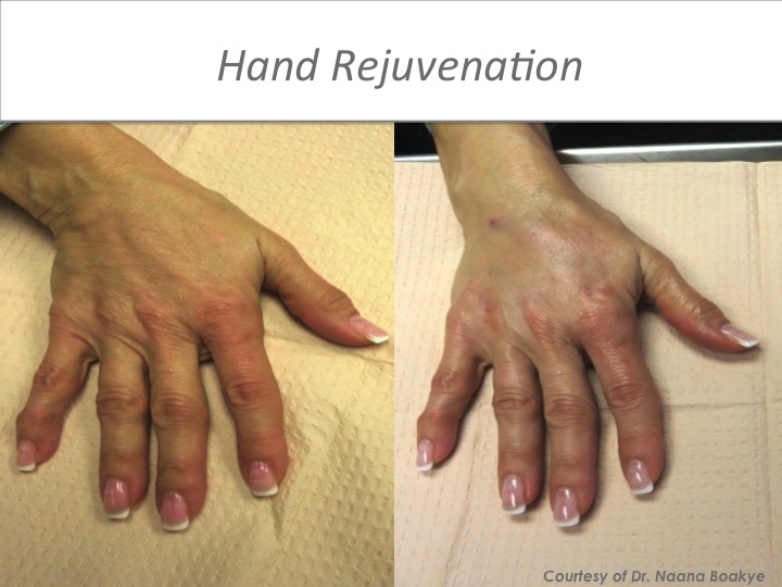 Hand Rejuevenation .jpeg