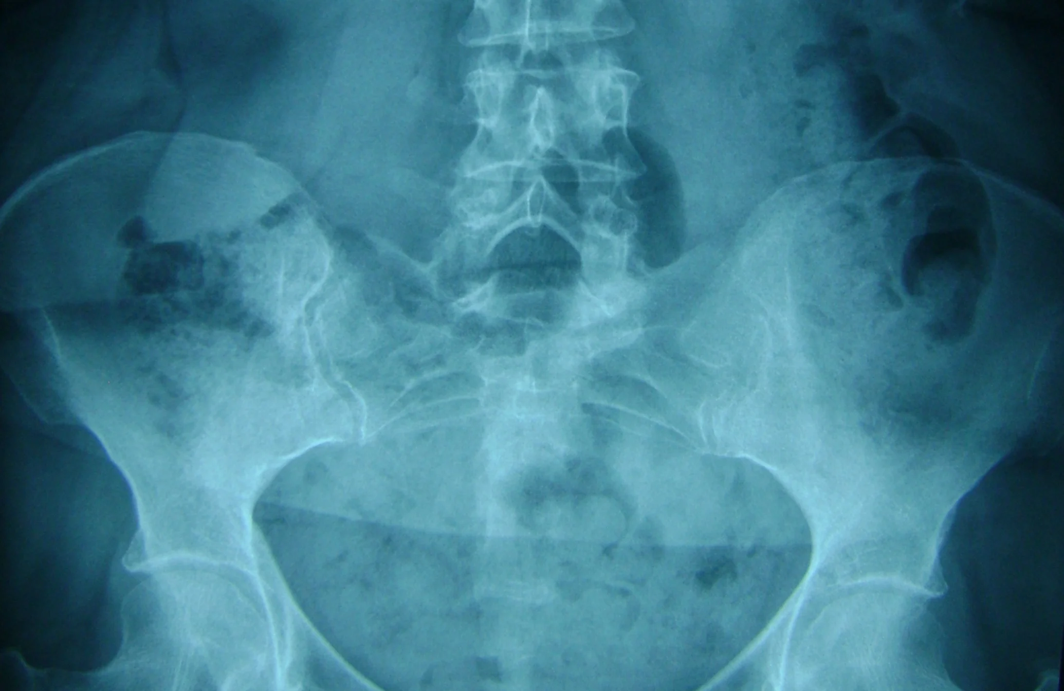 pelvic xray.jpg