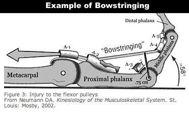 bowstringing-neumann-1.png