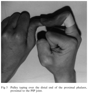 Image 3 - Schweizer Circumferential Tape at Distal End of Phalanx.png