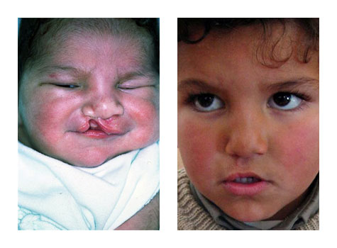 left-unilateral-cleft-lip-a.jpg