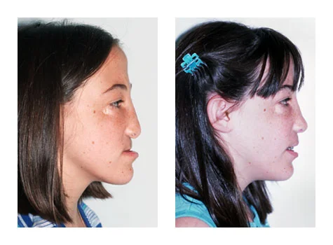 midline cleft.jpg
