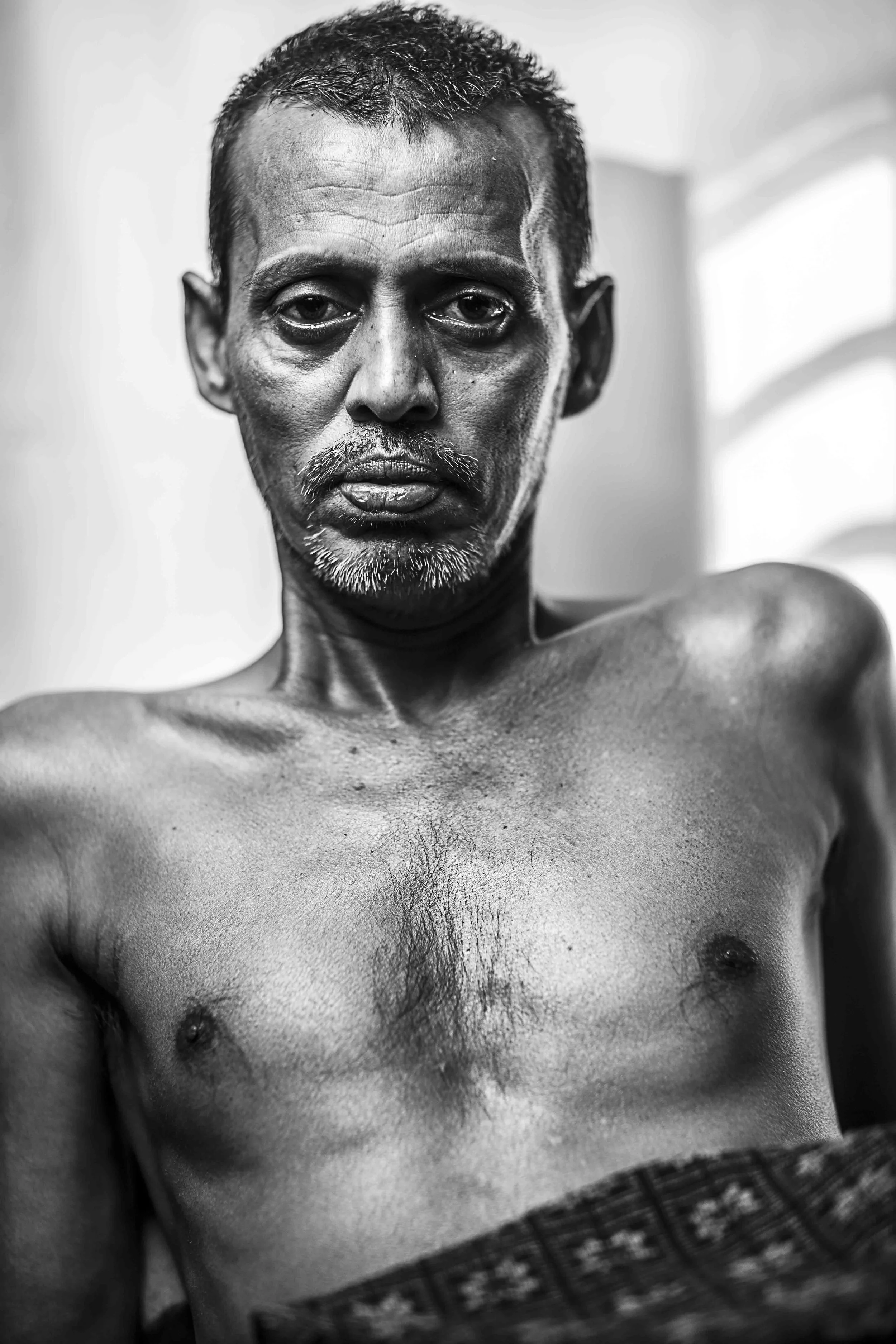 Mohammad Rubel Mia, an automated rickshaw driver from Comilla, admitted to Dhaka Medical College Hospital (DMCH) on the 26/11/2013. He received burns to 25% of his body when miscreants threw a petrol bomb into his automated rickshaw in Chittagong.